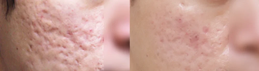 Before and after: acne & pore scars
