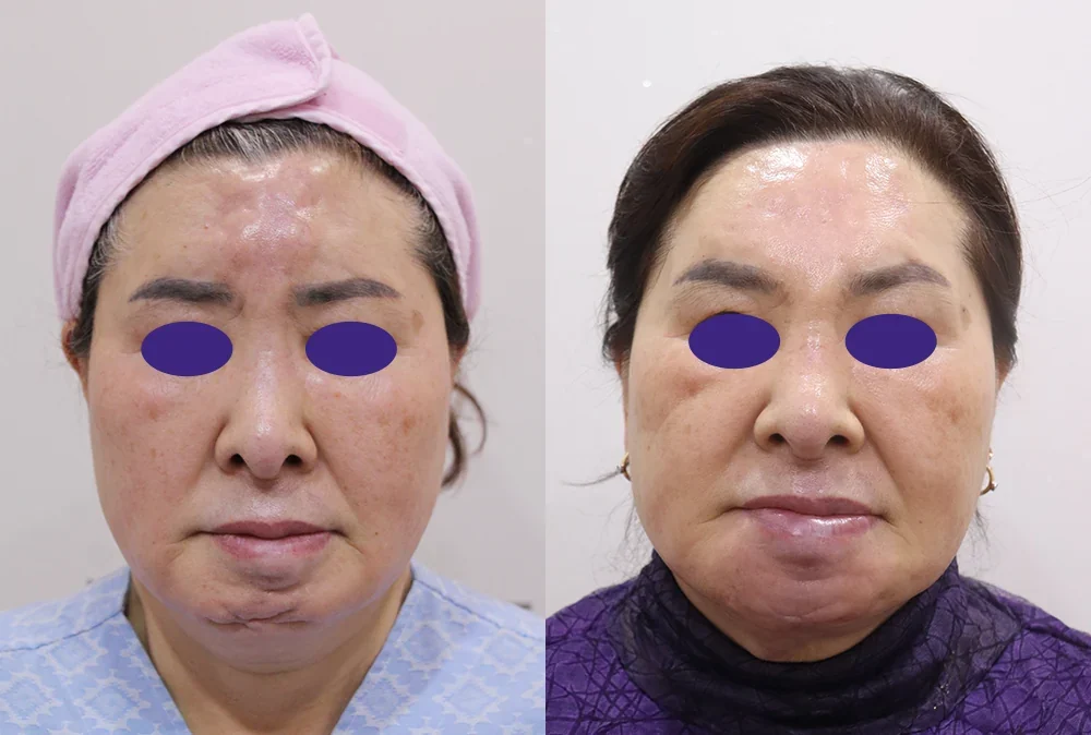 Before and after: multi lifting after foreign-body removal