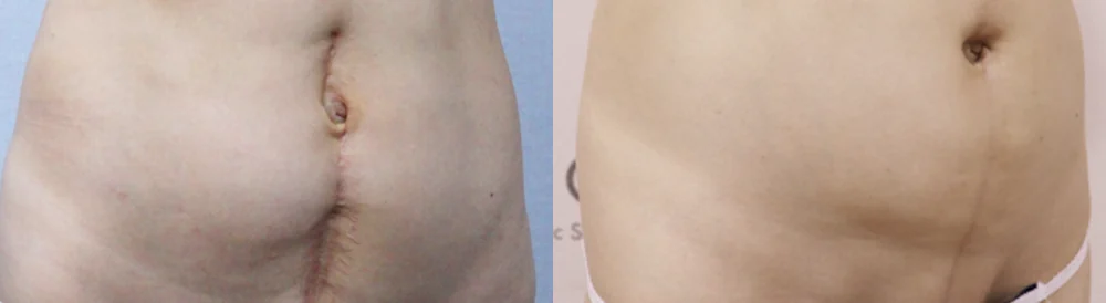 사고 흉터 시술 전후 사진 40 · 보니따의원