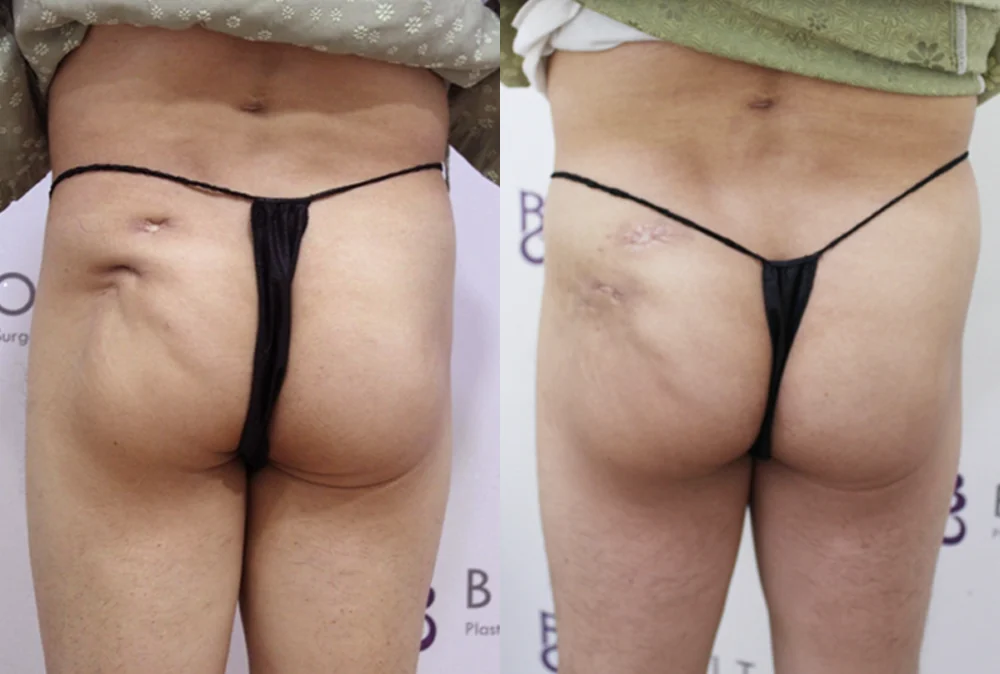 사고로 생긴 패인 흉터, 시기에 따라 치료가 어떻게 달라질까요? · 전후 사진 1