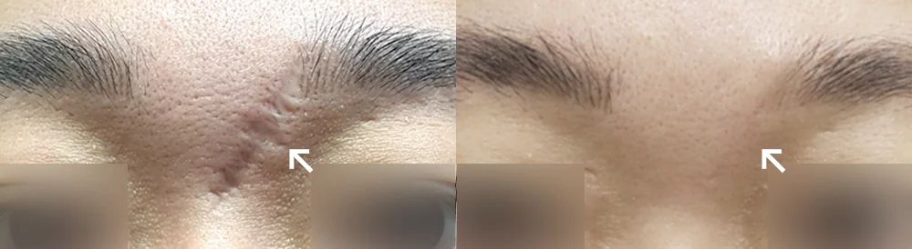 사고 흉터 시술 전후 사진 46 · 보니따의원