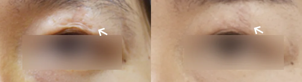 사고 흉터 시술 전후 사진 51 · 보니따의원