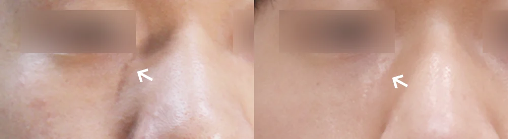 사고 흉터 시술 전후 사진 52 · 보니따의원