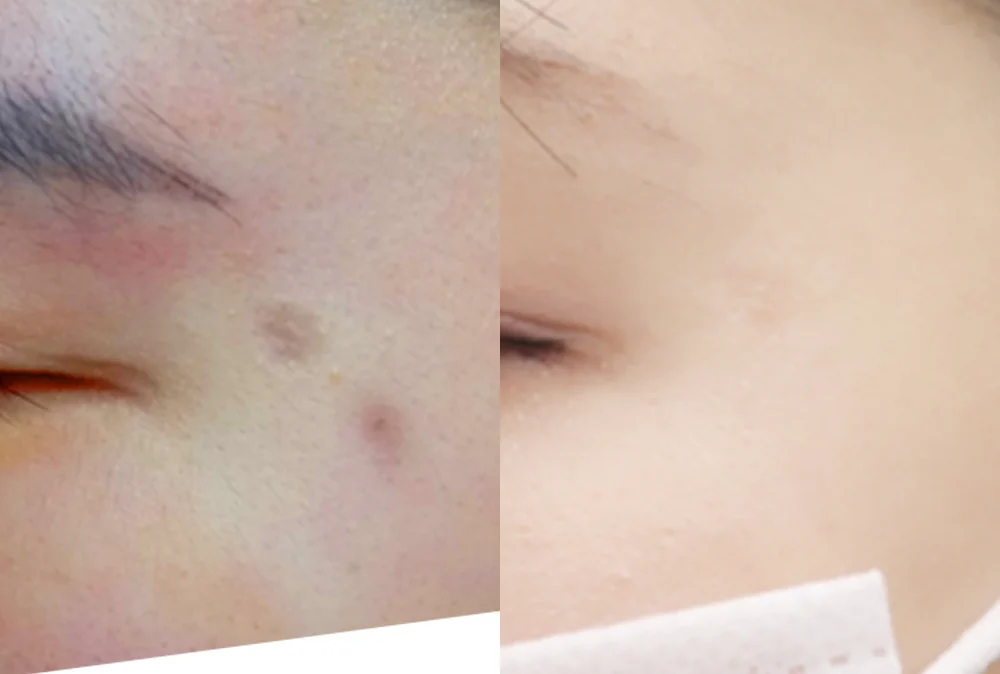 사고로 생긴 패인 흉터, 시기에 따라 치료가 어떻게 달라질까요? · 전후 사진 4