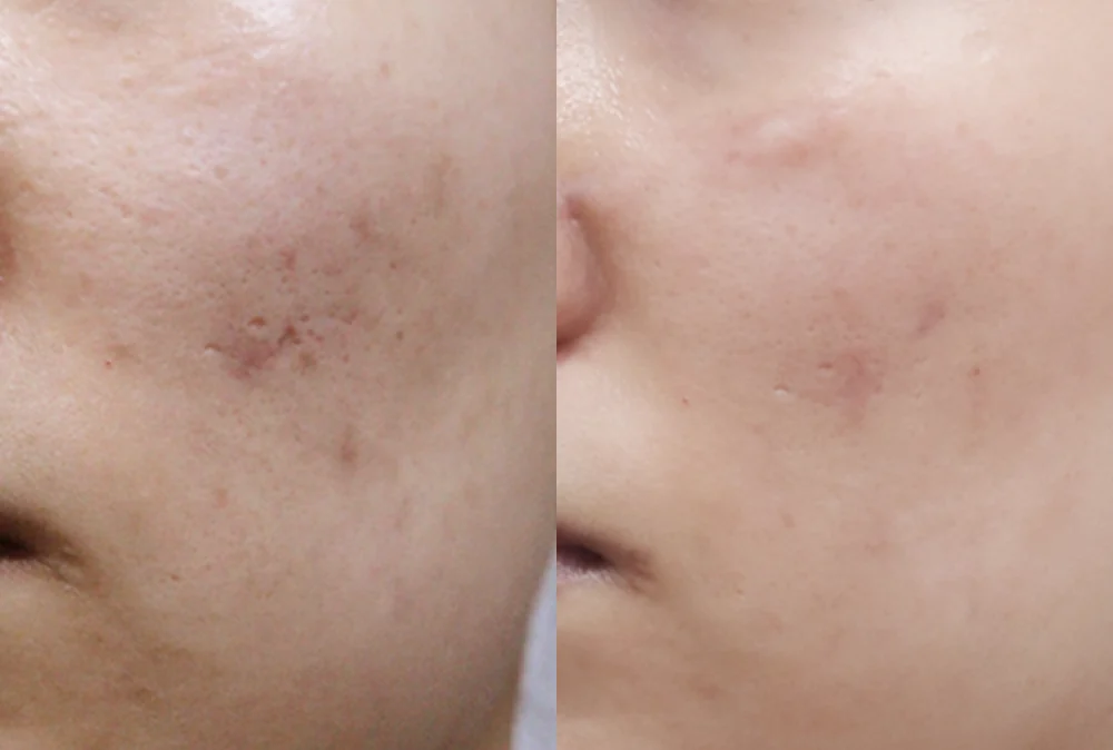 사고 흉터 시술 전후 사진 28 · 보니따의원