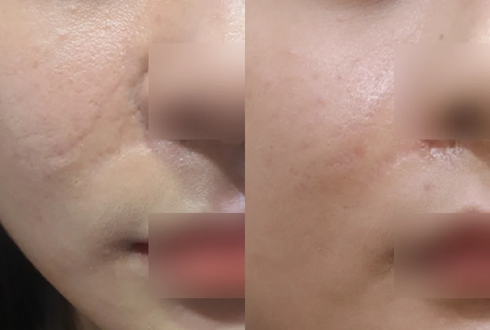 사고 흉터 시술 전후 사진 29 · 보니따의원