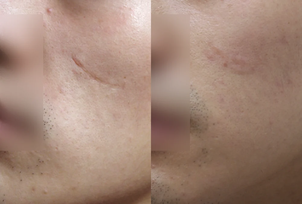 사고 흉터 시술 전후 사진 30 · 보니따의원