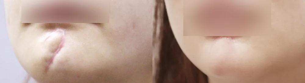 사고 흉터 시술 전후 사진 54 · 보니따의원