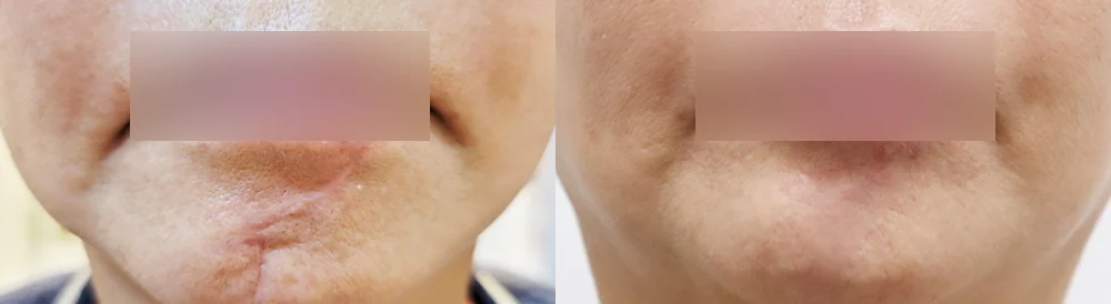 사고 흉터 시술 전후 사진 55 · 보니따의원