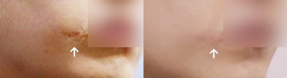 사고 흉터 시술 전후 사진 57 · 보니따의원