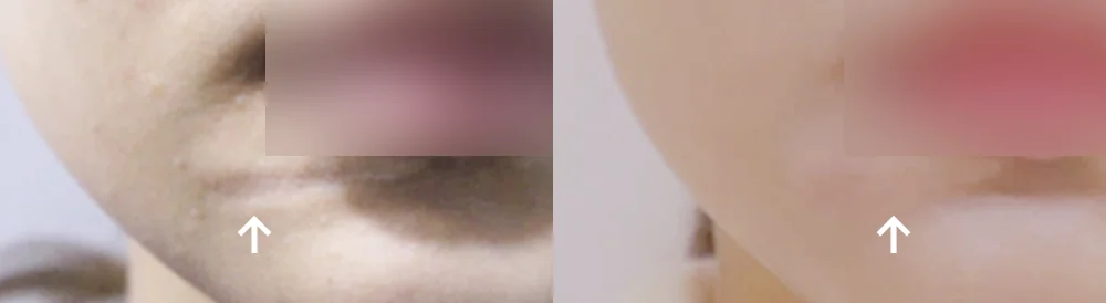 사고 흉터 시술 전후 사진 59 · 보니따의원