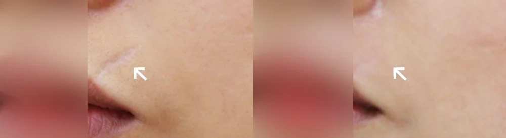사고 흉터 시술 전후 사진 60 · 보니따의원