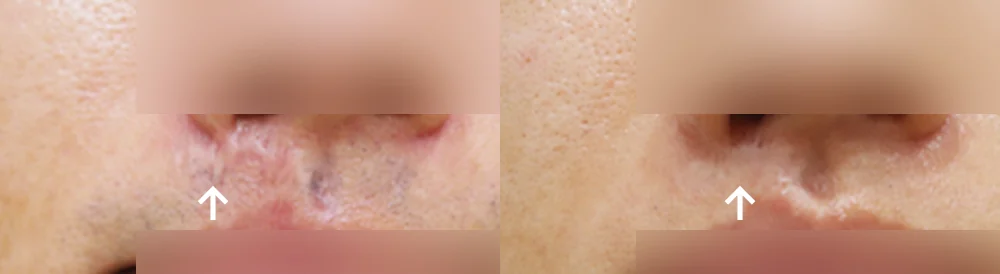 사고 흉터 시술 전후 사진 64 · 보니따의원
