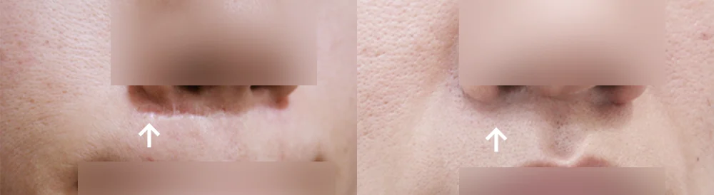 사고 흉터 시술 전후 사진 67 · 보니따의원