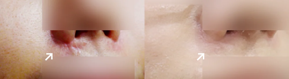 사고 흉터 시술 전후 사진 69 · 보니따의원