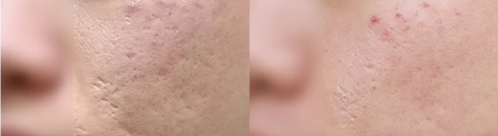 여드름·모공 흉터 시술 전후 사진 16 · 보니따의원