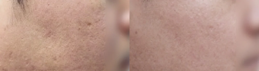 여드름·모공 흉터 시술 전후 사진 18 · 보니따의원