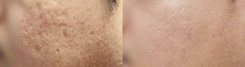 레이저를 여러 번 받았는데 왜 여드름 흉터는 그대로일까요? · 전후 사진 3