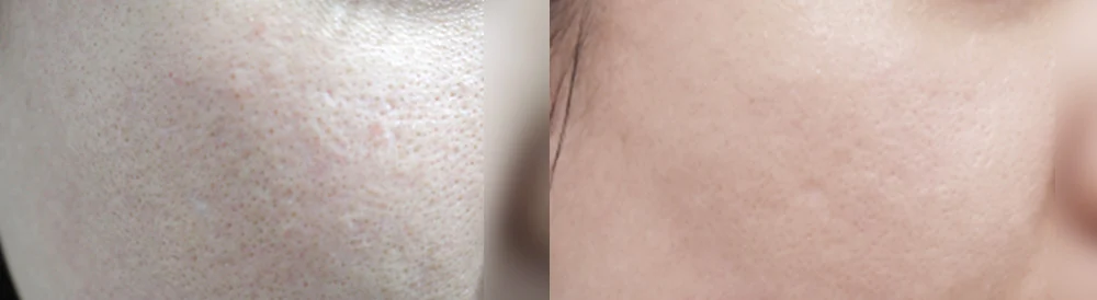 여드름·모공 흉터 시술 전후 사진 28 · 보니따의원