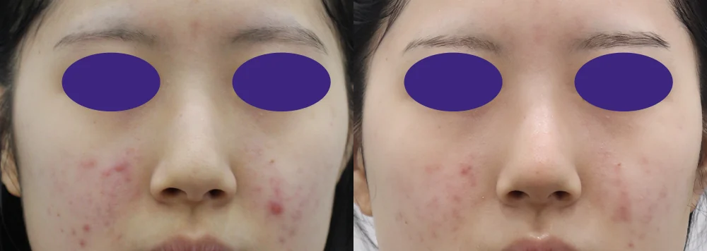 코 성형 시술 전후 사진 13 · 보니따의원