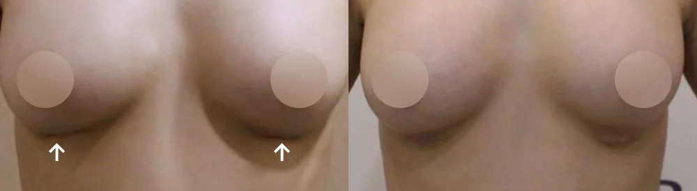 Body 패인·절개 흉터 시술 전후 사진 17 · 보니따의원