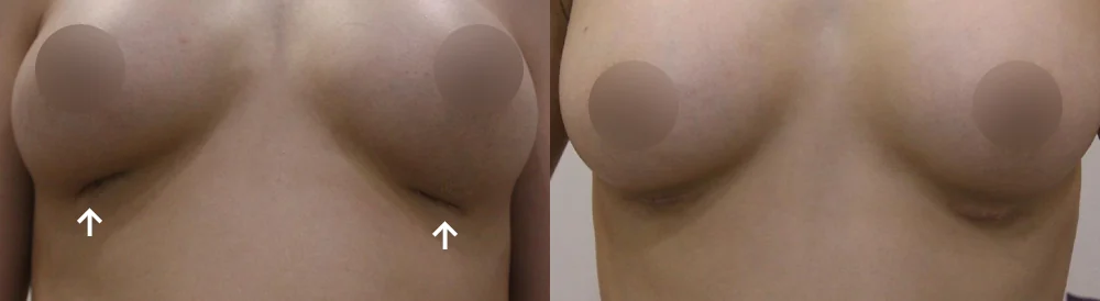 Body 패인·절개 흉터 시술 전후 사진 18 · 보니따의원
