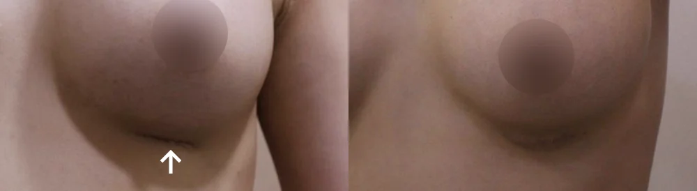 Body 패인·절개 흉터 시술 전후 사진 19 · 보니따의원