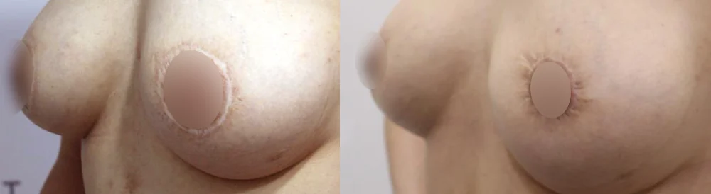 Body 패인·절개 흉터 시술 전후 사진 22 · 보니따의원