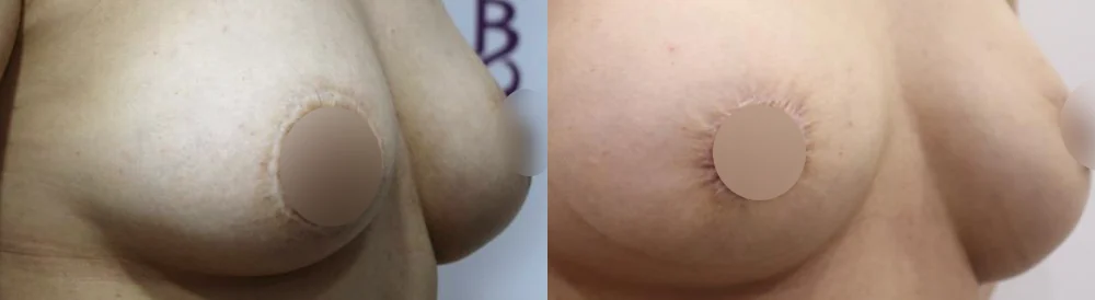 Body 패인·절개 흉터 시술 전후 사진 23 · 보니따의원