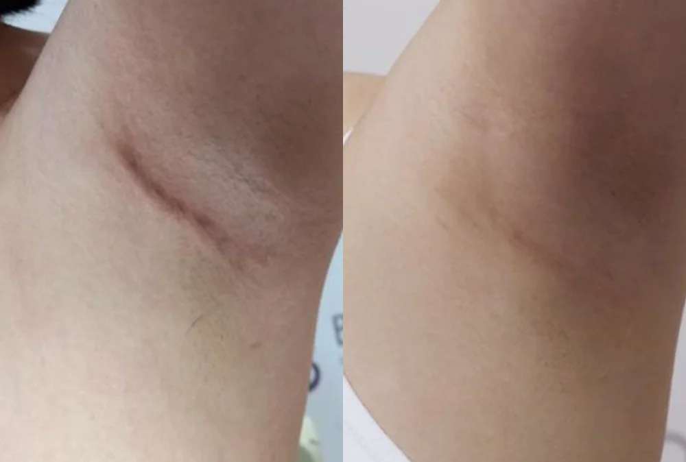 Body 패인·절개 흉터 시술 전후 사진 1 · 보니따의원