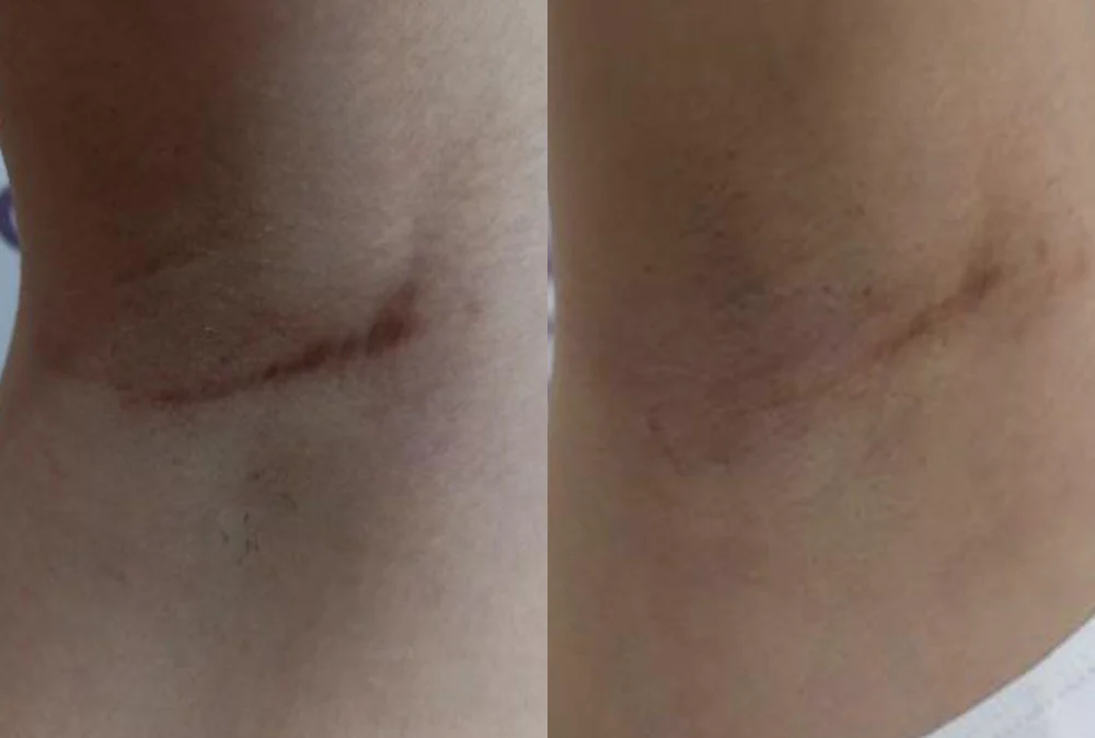Body 패인·절개 흉터 시술 전후 사진 2 · 보니따의원