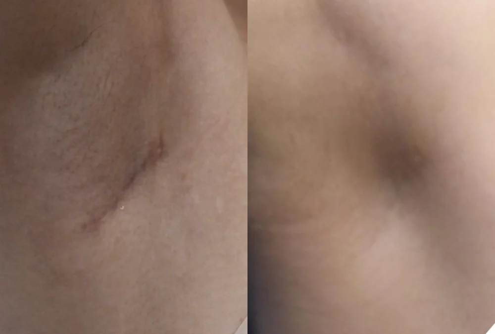 Body 패인·절개 흉터 시술 전후 사진 3 · 보니따의원