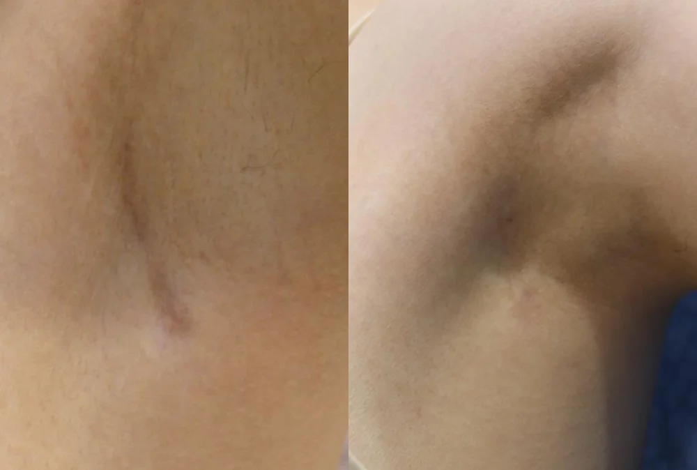Body 패인·절개 흉터 시술 전후 사진 4 · 보니따의원