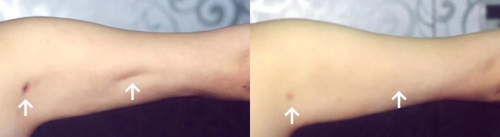 Body 패인·절개 흉터 시술 전후 사진 24 · 보니따의원