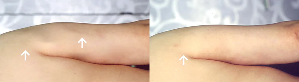 Body 패인·절개 흉터 시술 전후 사진 25 · 보니따의원