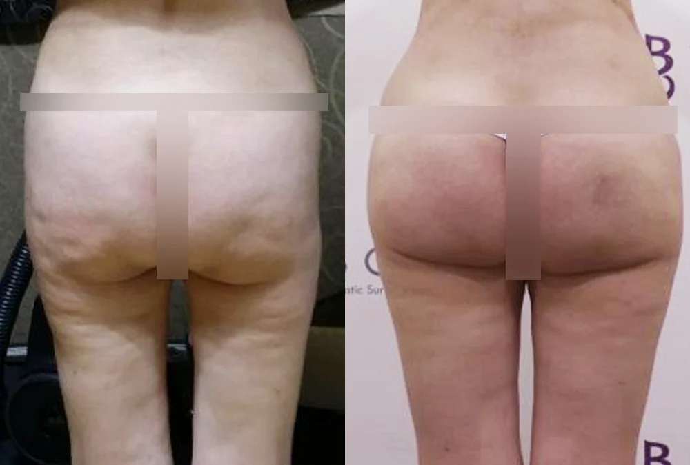 Body 패인·절개 흉터 시술 전후 사진 5 · 보니따의원