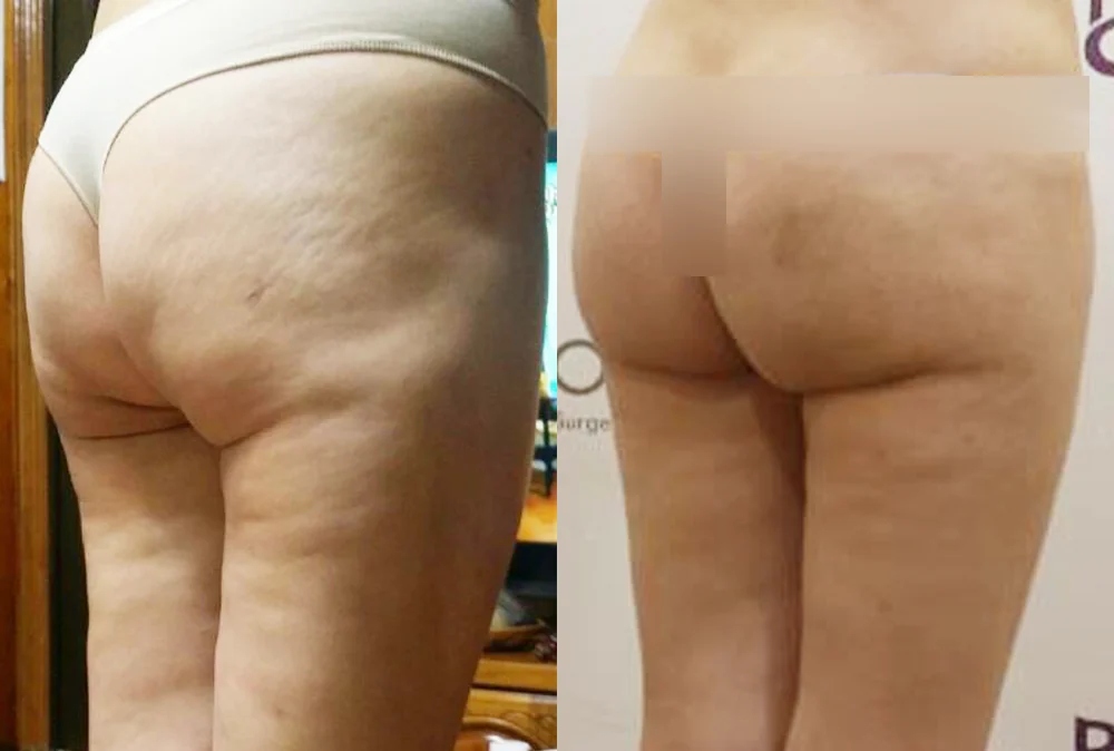 Body 패인·절개 흉터 시술 전후 사진 8 · 보니따의원