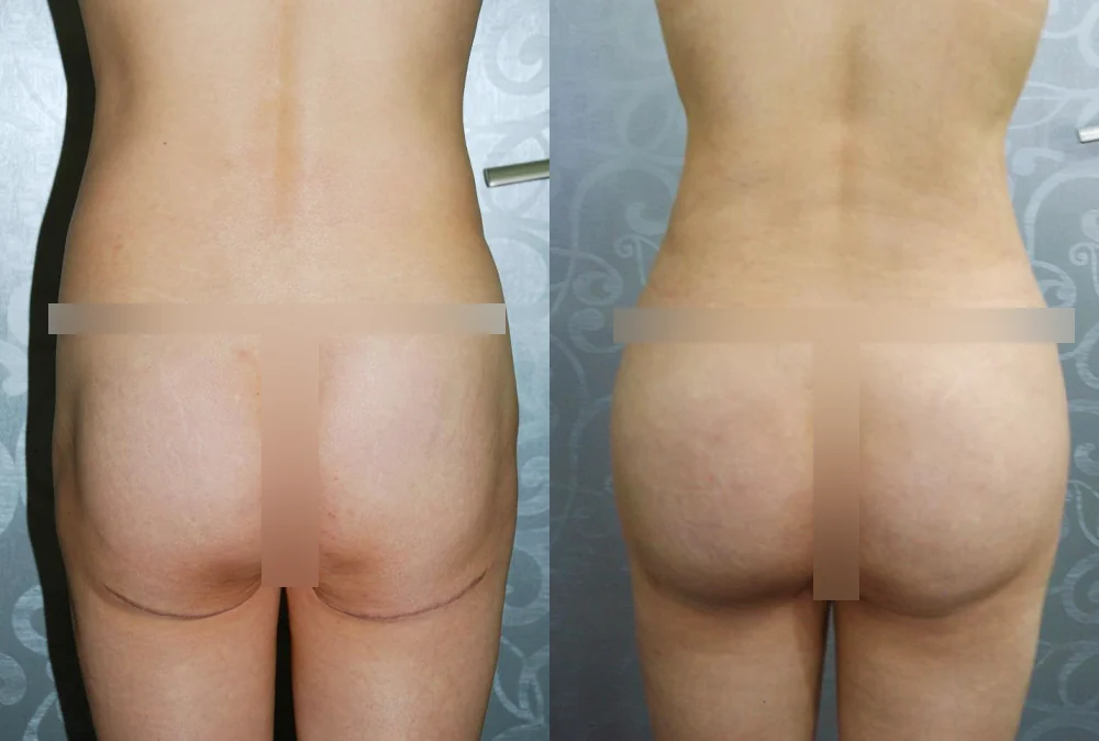 Body 패인·절개 흉터 시술 전후 사진 10 · 보니따의원
