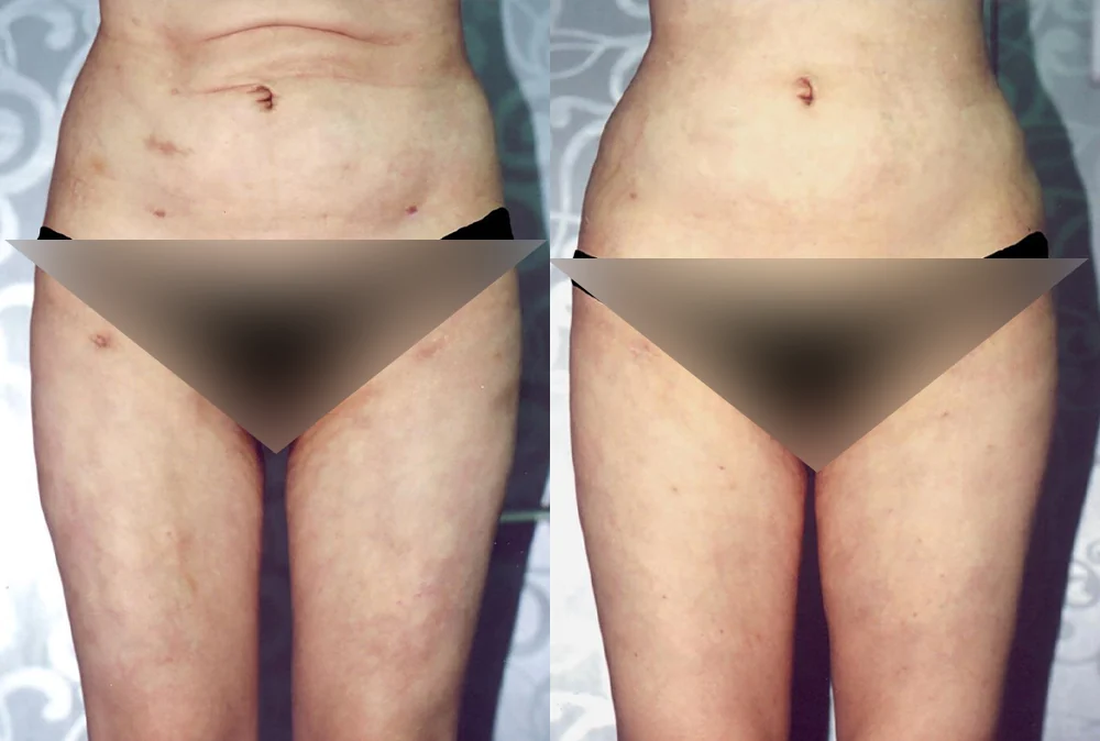 Body 패인·절개 흉터 시술 전후 사진 11 · 보니따의원