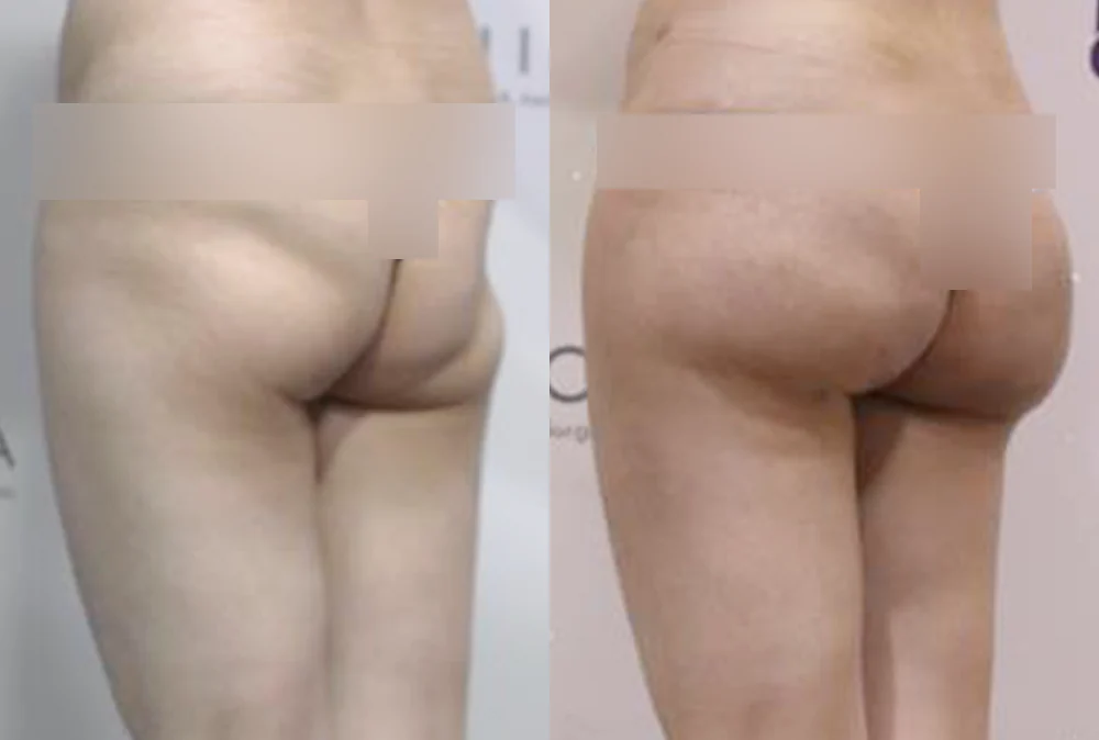 Body 패인·절개 흉터 시술 전후 사진 12 · 보니따의원