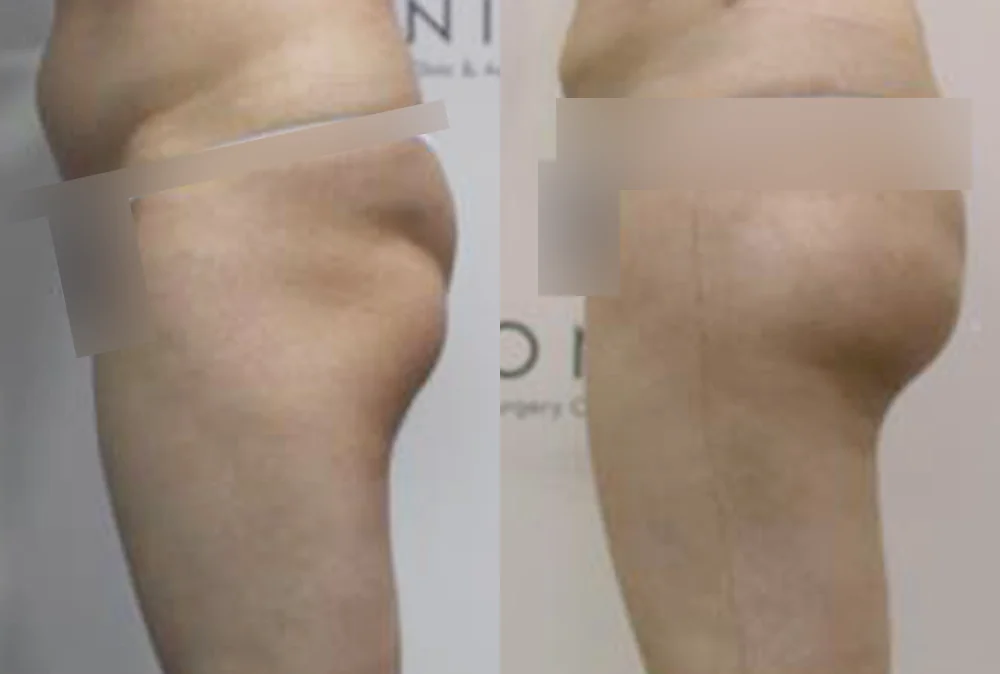 Body 패인·절개 흉터 시술 전후 사진 13 · 보니따의원