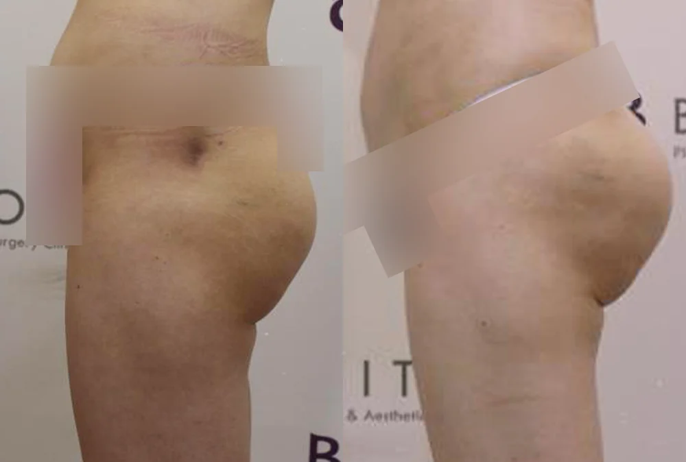 Body 패인·절개 흉터 시술 전후 사진 14 · 보니따의원