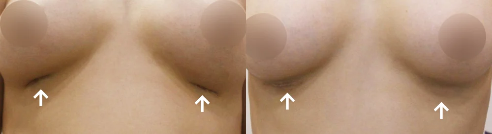 지방흡입·가슴 성형 뒤 남은 흉터와 요철, 다시 고칠 수 있을까요? · 전후 사진 1