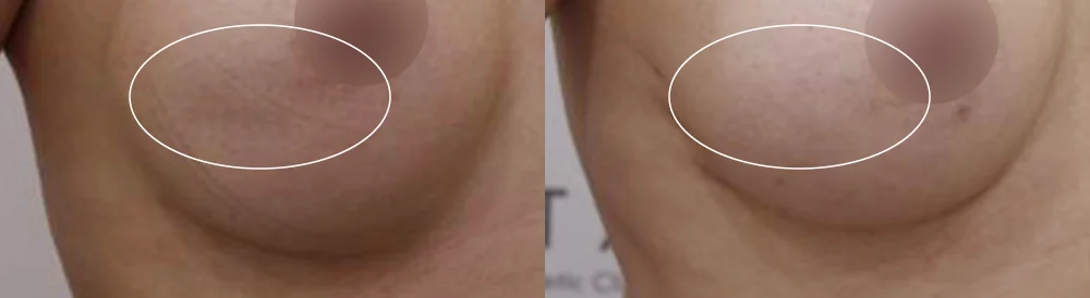 Body 성형 흉터 시술 전후 사진 18 · 보니따의원