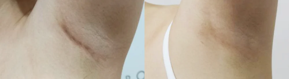 지방흡입·가슴 성형 뒤 남은 흉터와 요철, 다시 고칠 수 있을까요? · 전후 사진 2