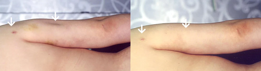 Body 성형 흉터 시술 전후 사진 27 · 보니따의원