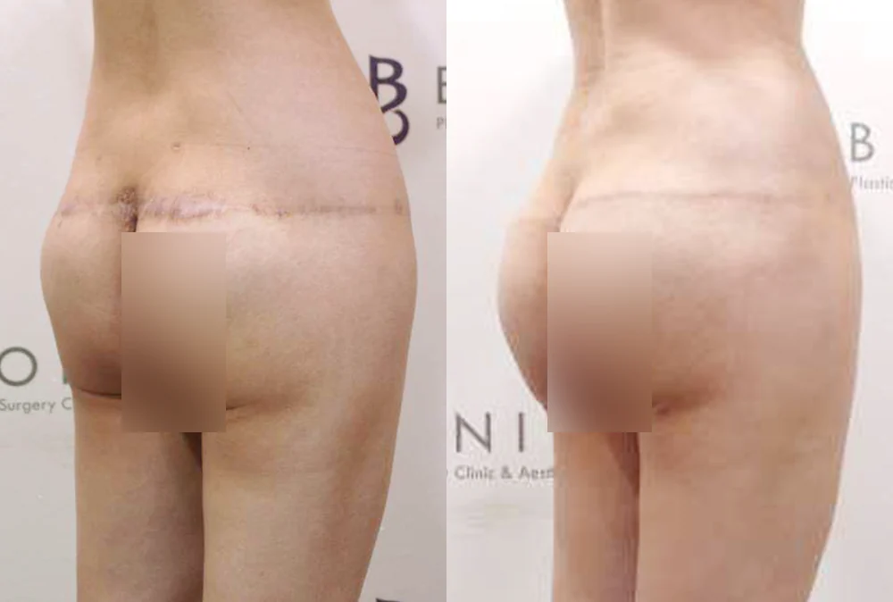 지방흡입·가슴 성형 뒤 남은 흉터와 요철, 다시 고칠 수 있을까요? · 전후 사진 4