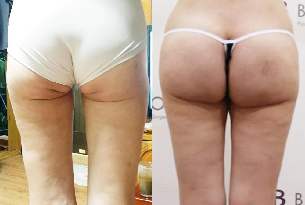 Body 성형 흉터 시술 전후 사진 2 · 보니따의원