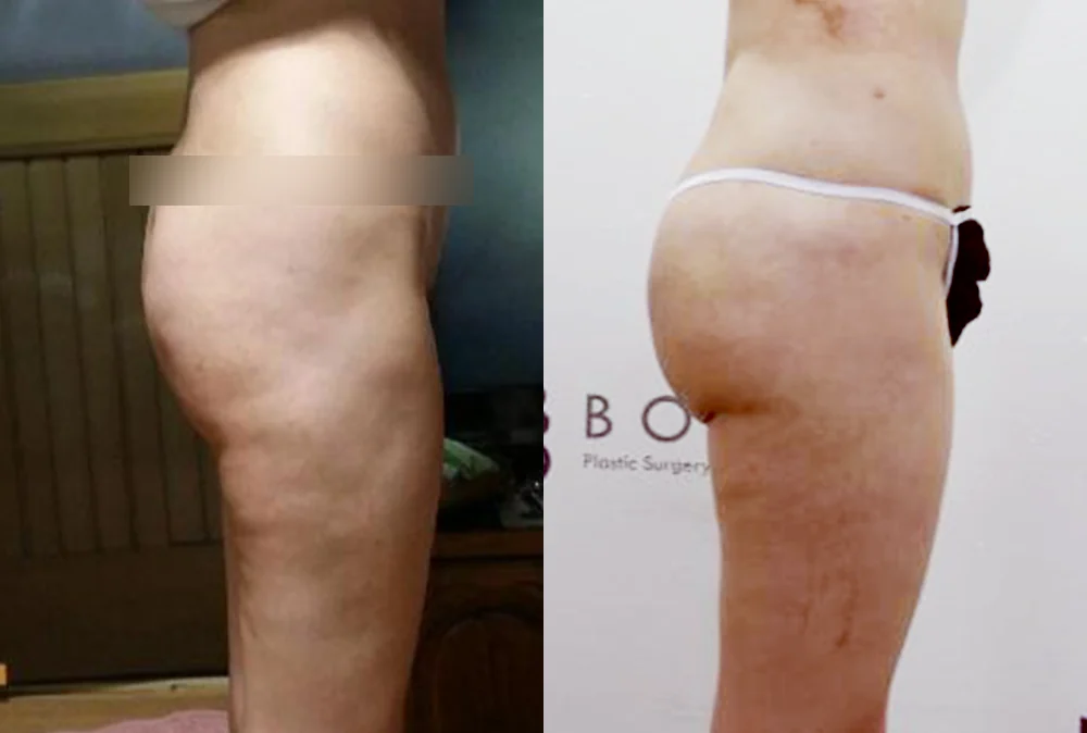 Body 성형 흉터 시술 전후 사진 7 · 보니따의원