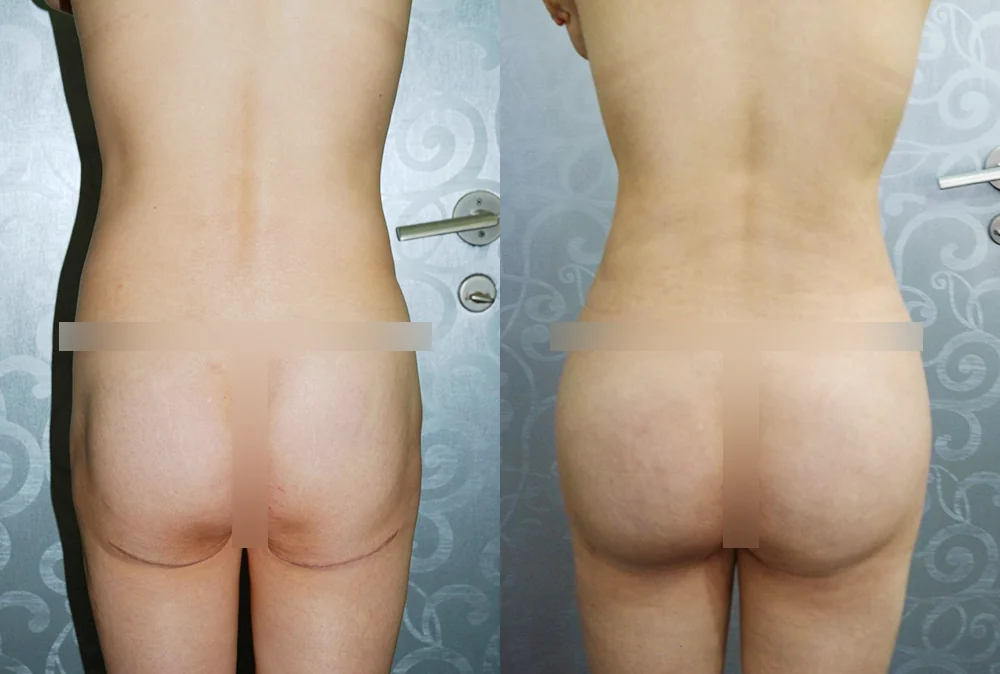 Body 성형 흉터 시술 전후 사진 9 · 보니따의원